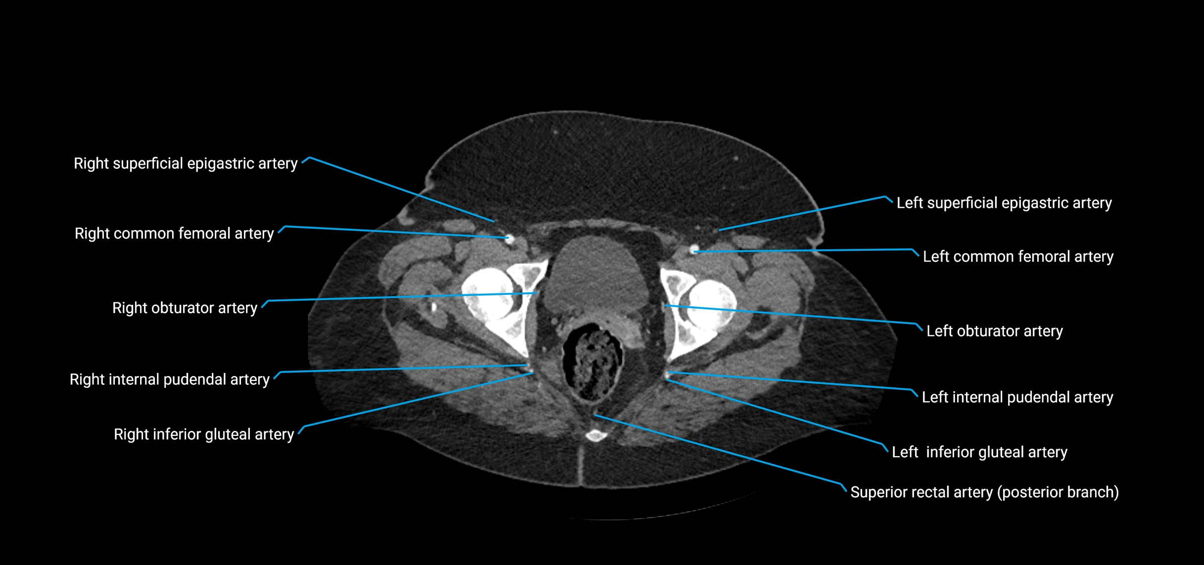 CTA abdomen axial cross sectional anatomy labelled image_245 (2).webp